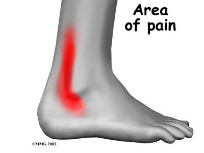 – 200905ankle peroneal tendinitis symptoms01