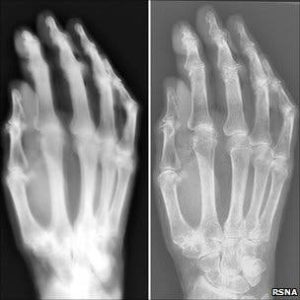 – 201103x ray hand