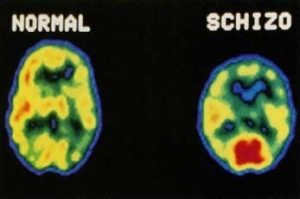 – 201105schizophrenia