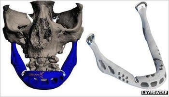 Computer model, next to the finished part of the lower jaw. (c) Layerwise