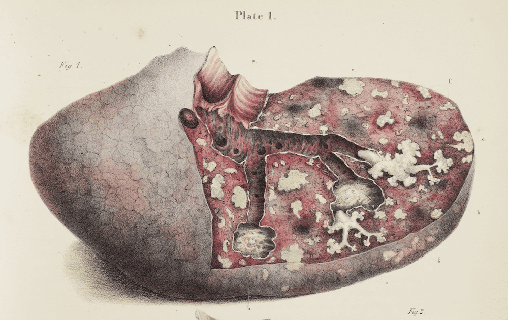 Carswell was a pathologist in London. Here he illustrates a lung from a patient with pulmonary tuberculosis, which was p<a href="http://ocp.hul.harvard.edu/contagion/tuberculosis.html">revalent in industrialized countries</a> in the 19th and early 20th centuries. A scientist first identified the microbe that caused the illness in 1882, long after Carswell made this drawing.