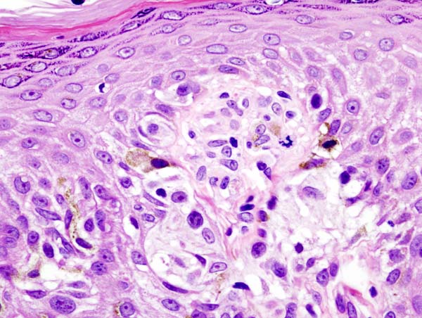 Rather than designing a drug to cure cancer, current research focuses on developing drugs to help the body fight cancer itself. Cancer vaccines would boost the body's own natural immune response so that naturally produced antibodies would attack the cancer cells and cure the disease. Currently, researchers have only tested the vaccine with melanoma [left], and the treatment still requires that the cancer fighting immune cells are altered in the lab and then returned to the body. However, once researchers figure out how to change the immune cells <em>in vivo</em>, it would only take a pill or a shot to get the body killing cancer for itself.