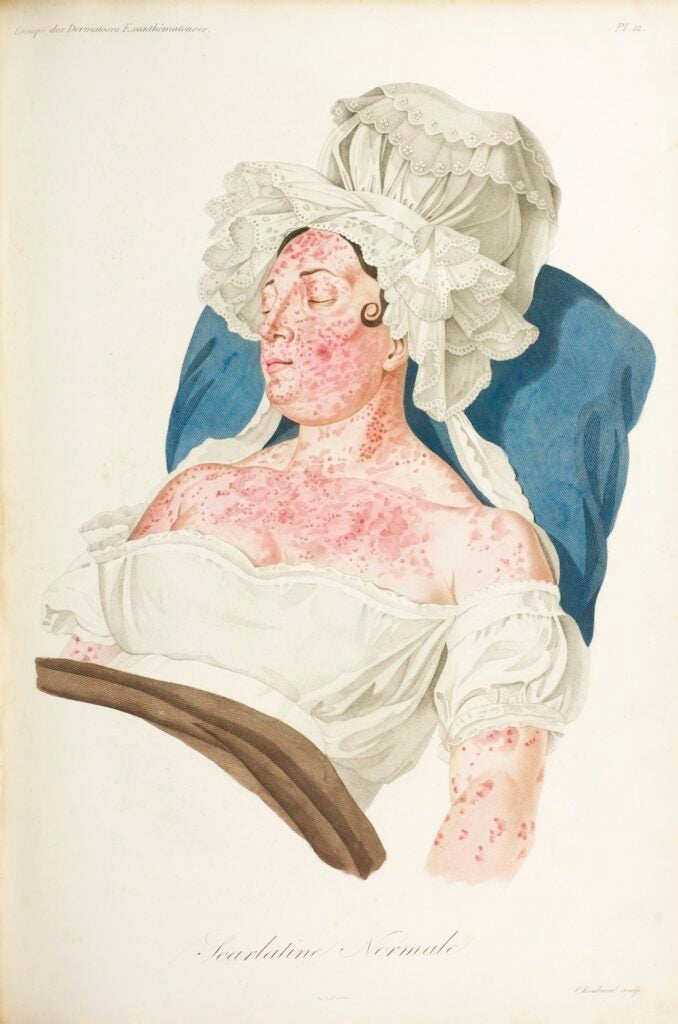 This illustration of a scarlet fever rash, made by a French dermatologist, also happens to show some fashions of the time.