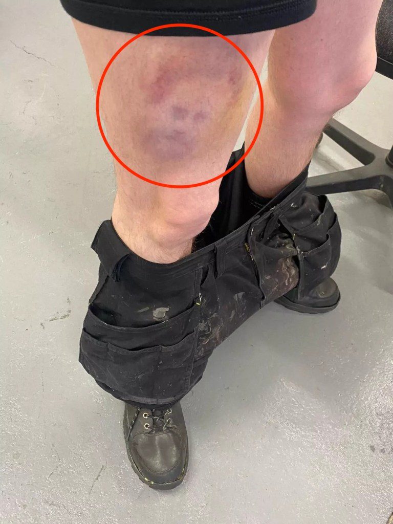 Story from Jam Press (Prince Harry Bruise) Pictured: The bruise on Adam???s leg which looks like Prince Harry???s face. Prince Harry???s face spotted in bruise on mans leg after football injury A shocked man injured in a five-a-side footy match noticed the bruise was shaped like Prince Harry???s face. Adam Price was playing with some pals and got a knock. He went for a 50/50 ball with the goalkeeper. But the 37-year-old was unable to score and got clattered during the game in Birmingham. But when Adam glanced down at his right leg he spotted a familiar sight. The blue mark was a dead ringer for the Duke of Sussex. The bruise had marks like his trademark beard at the bottom and hair at the top. The outline was completed with patches that resembled two eyes and a nose as well. ENDS The article features on What???s The Jam.