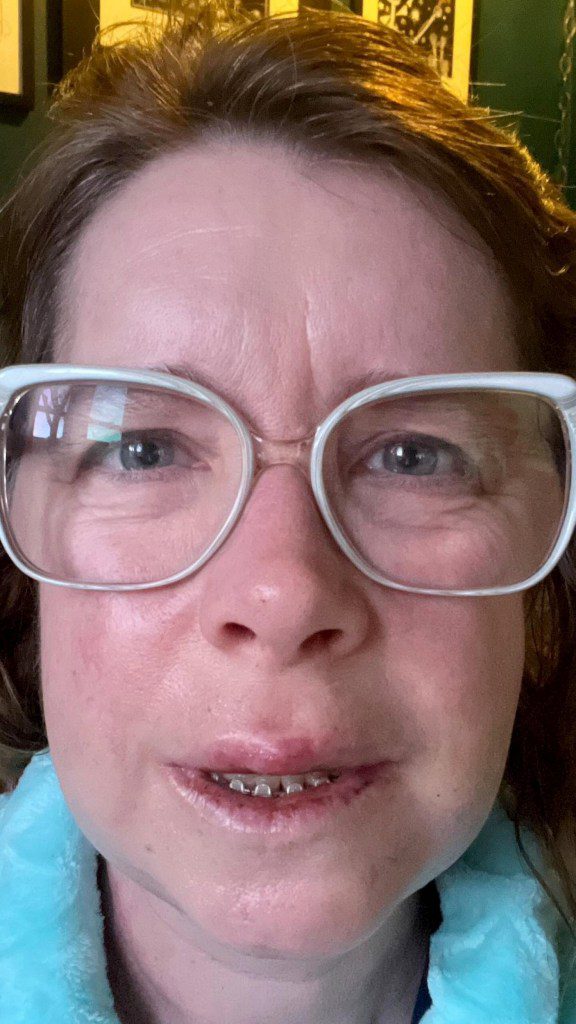 Jennifer Markey, three days after double jaw treatment - February 3, 2024. Release date ? March 18, 2024. SWSMteeth. A woman who said she looked like a 