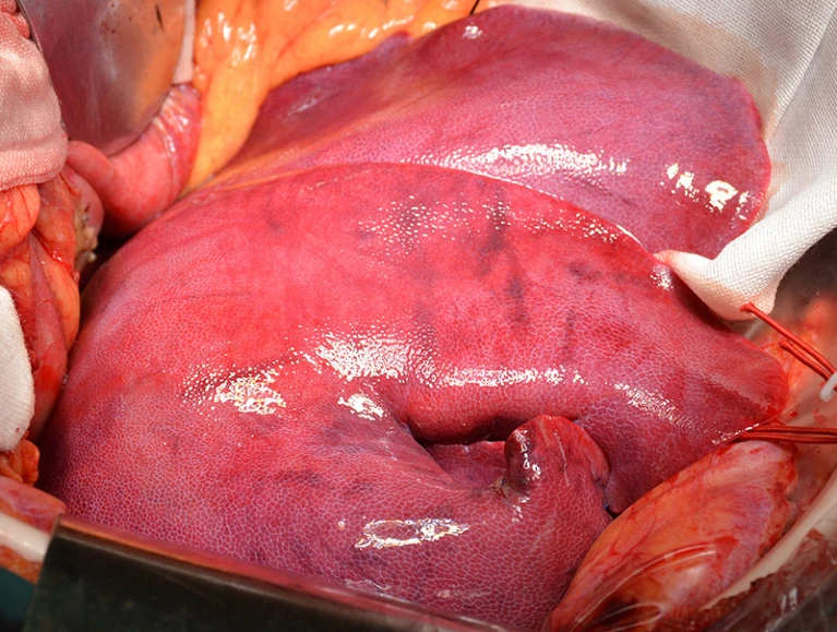 A close-up view of the pig liver during the xenotransplantation