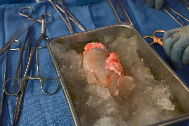 The modified pig kidney. (MGH photo)