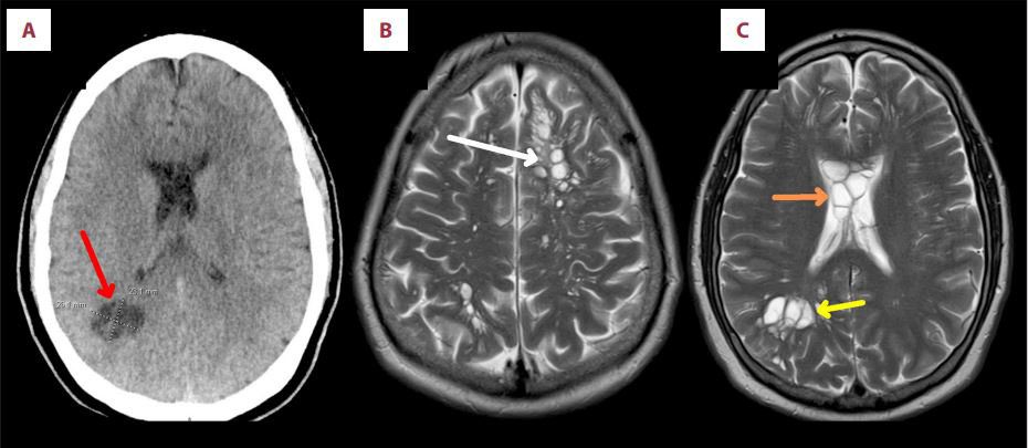 Brain scans showing the worm eggs in the man’s brain (Picture: Emily Joshu)