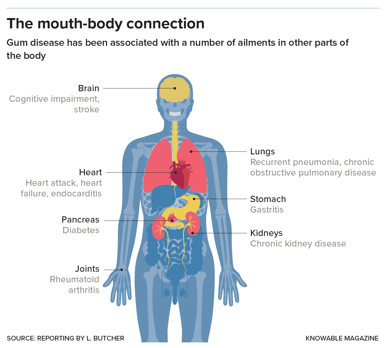 Dental ailments, including gum disease, have been linked to numerous health problems elsewhere in the body. Credit: Knowable Magazine