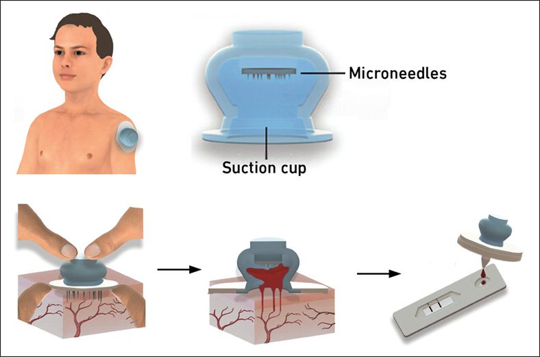 Schematic blood sampling device